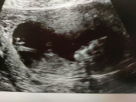 12 week scan
